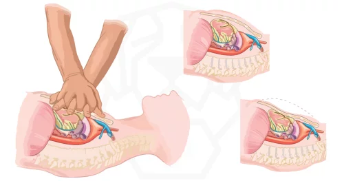 Une solution efficace pour la réanimation cardiaque